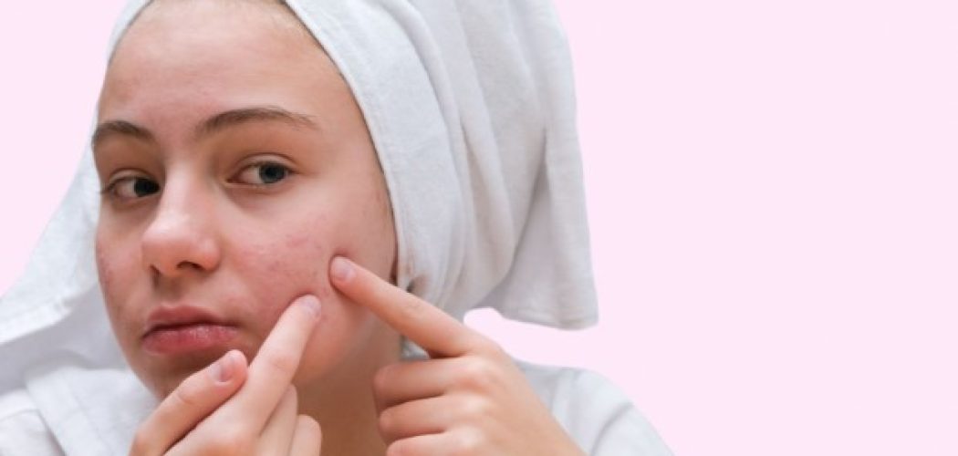 Si te trajtojme aknet ne menyre natyrale ne Shtepi?