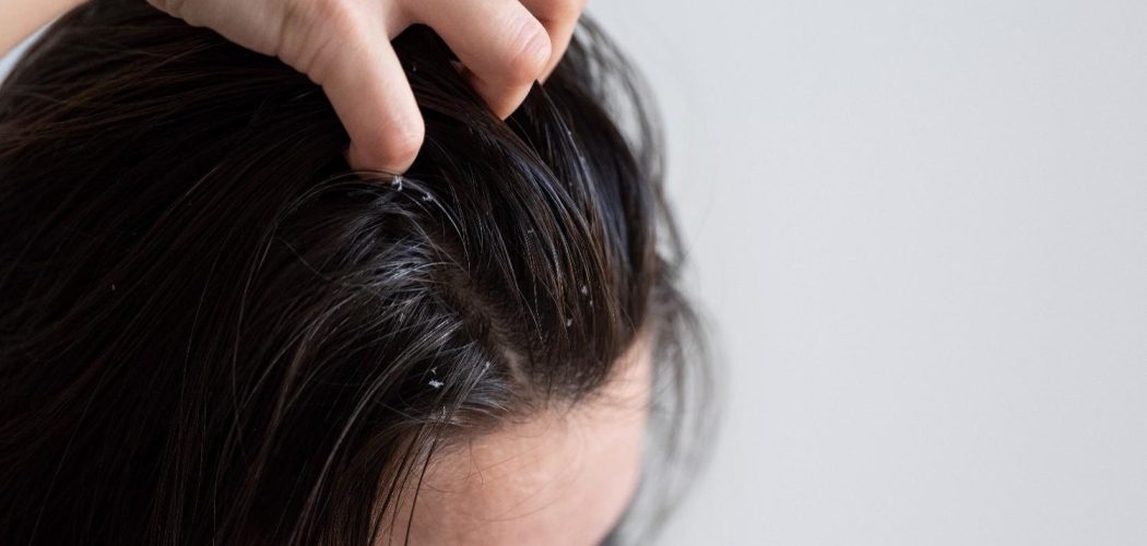 close-up-woman-with-dandruff-issues2