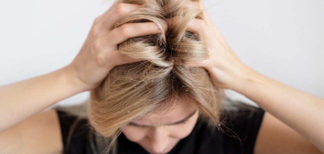 close-up-woman-with-dandruff-problems (1)
